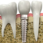 Dental Implants, Chilliwack Dentist